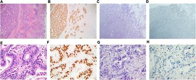 Circulating Epstein-Barr virus DNA associated with hepatic impairment and its diagnostic and prognostic role in patients with gastric cancer